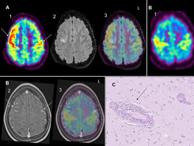 Case Report: Interest of Positron Emission Tomography in Pediatric Small Vessel Primary Angiitis of the Central Nervous System